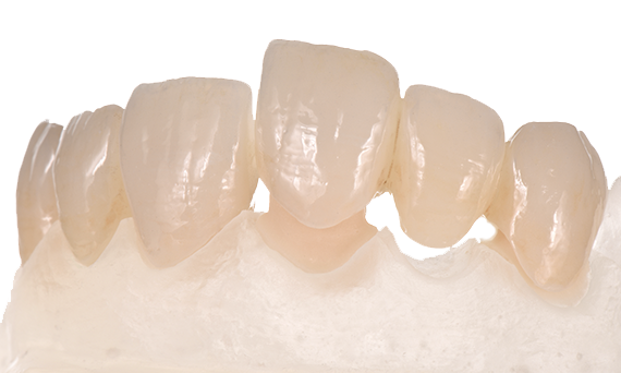 image of a restoration with Celtra Press