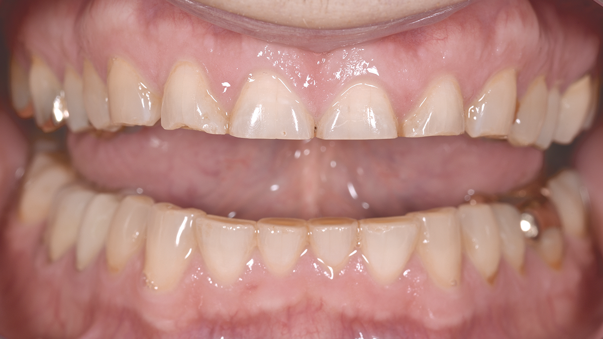 Celtra Press | Clinical Case | Inital Situation