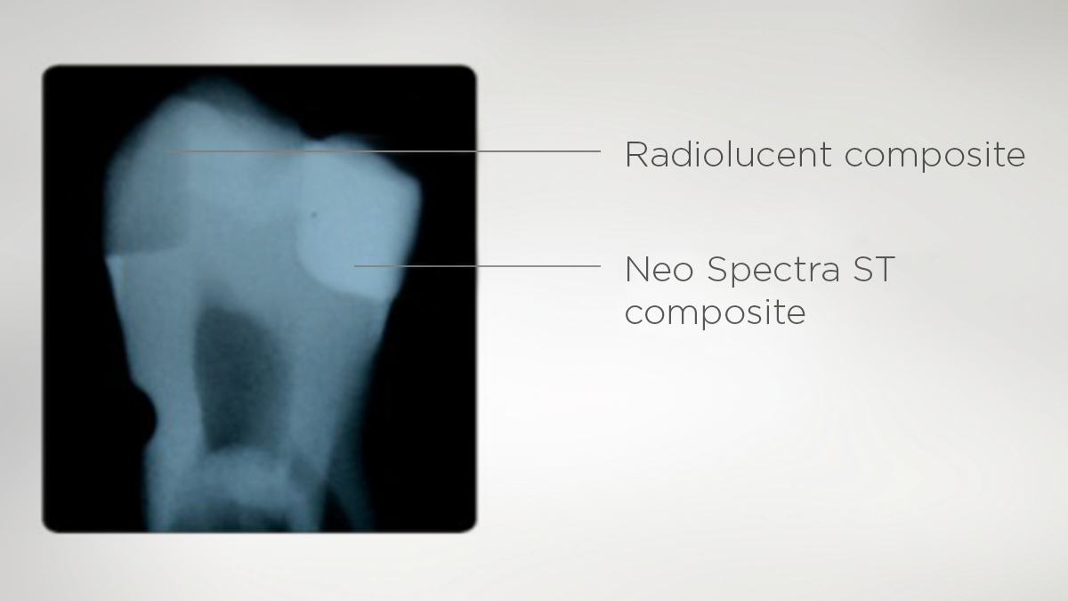 Excellent radiopacity