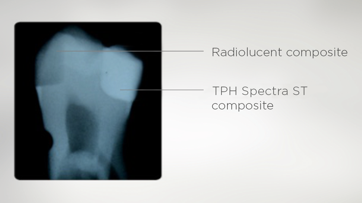 Excellent radiopacity