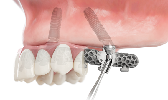 Screw-retained solutions