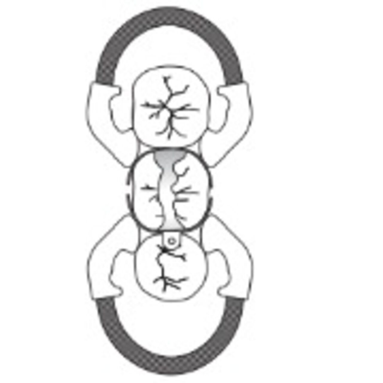Palodent V3 / Plus - Use Case Mesial-Occlusal-Distal