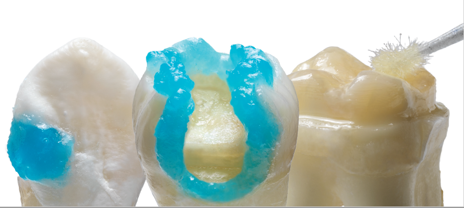 Prime&Bond elect Universal Dental Adhesive Toot Application